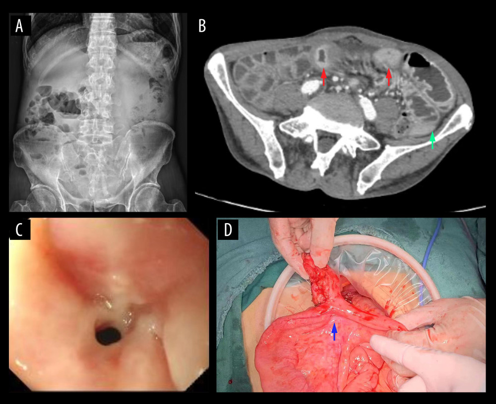 Auxiliary examination and intraoperative photograph. (A) Plain abdominal radiography showed incomplete intestinal obstruction. The costophrenic angle was sharp, and no obvious signs of free gas were observed under the 2 diaphragms. Abdomen was distended, and there was dilated bowel loops with air-fluid levels in the middle abdomen, which showed a step-like distribution. The small amount of fecal and gas shadows was scattered in some colons. (B) Abdominal enhanced CT showed that some small bowel walls were thickened, about 2.1 cm at the thickest point, and the lumen was significantly narrowed. Red arrows indicate marked thickening of the intestinal wall of the small bowel with luminal narrowing. Green arrows indicate colonic effusion with air-fluid level. (C) Double-balloon enteroscopy showed significant narrowing of the intestinal lumen and difficulty in passing the enteroscope. (D) Photograph of small-intestine stenosis during surgery. Blue arrows indicate the site of stenosis.