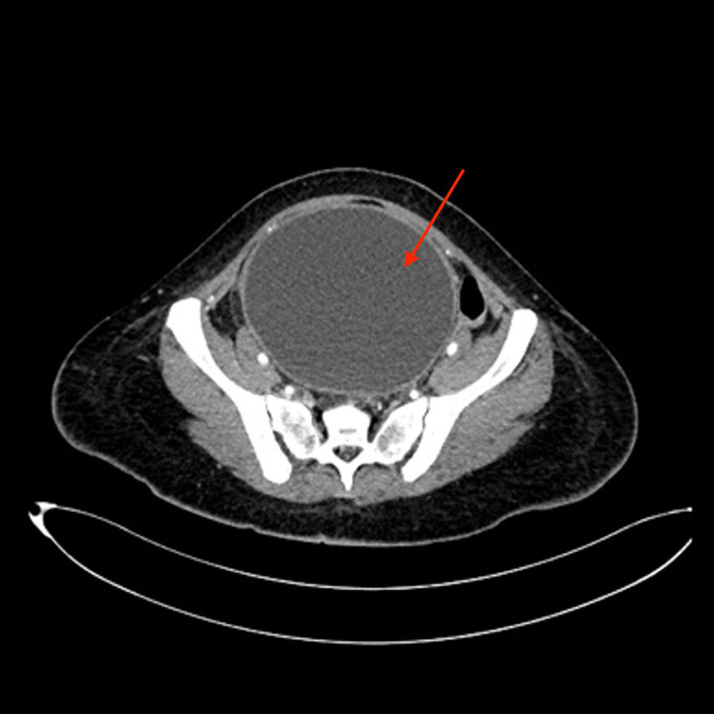 Axial view showing a well-circumscribed central pelvic cystic “mass” (red arrow). No solid component, internal septation, or calcification is seen.