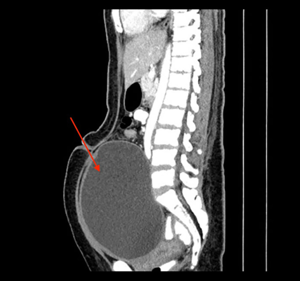 Sagittal view showing this “mass” (red arrow) is an overdistended urinary bladder extending up to third lumbar vertebral level. The uterus is normal, pushed posteriorly and inferiorly below the overdistended urinary bladder.