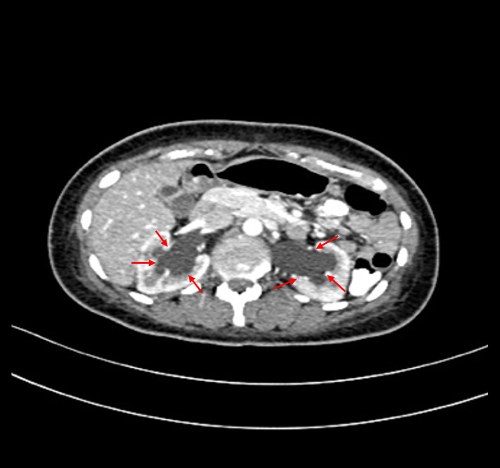 Axial view showing bilateral moderate hydronephrosis (red arrows) caused by distal ureteric compression by the “mass”.