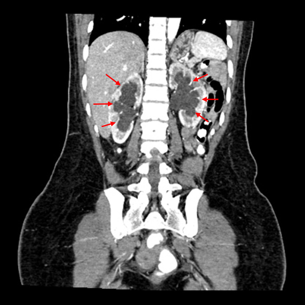 Coronal view showing bilateral moderate hydronephrosis (red arrows) caused by distal ureteric compression by the “mass”.