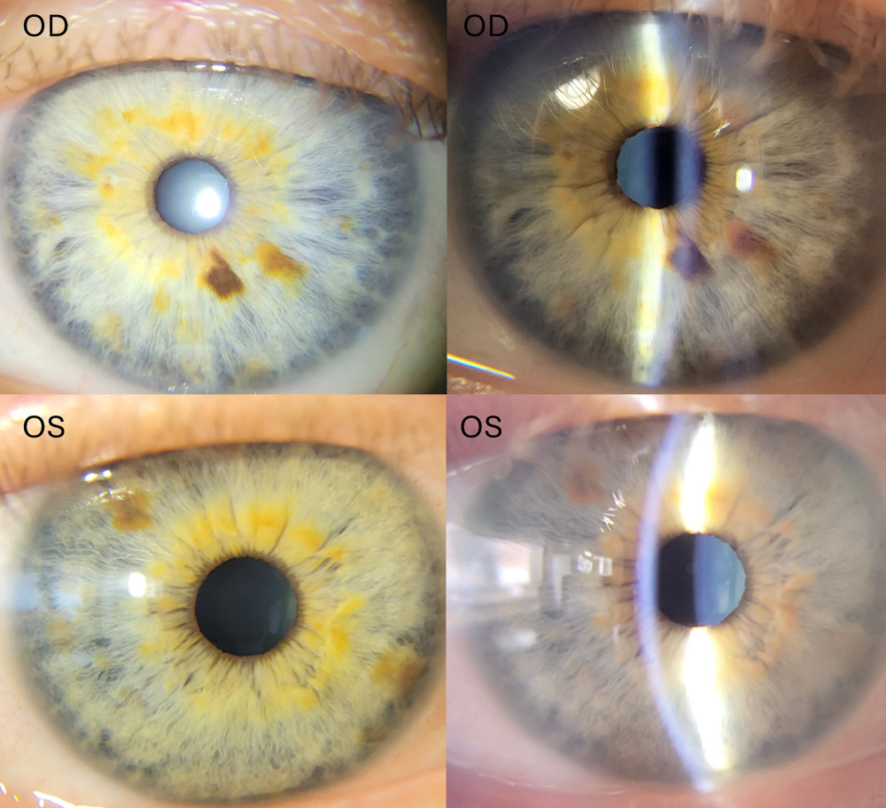 Slit-lamp photograph. The patient presented with a clear cornea, a deep and optically empty anterior chamber, and a clear crystalline lens in both eyes.
