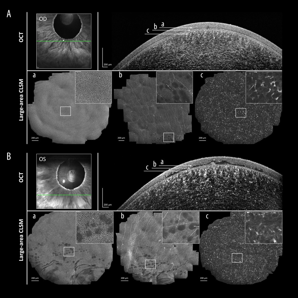 (A, B) Correlative imaging using high-resolution optical coherence tomography (OCT) and large-area confocal laser scanning microscopy (CLSM). Non-invasive biophotonic imaging of asymptomatic corneas ((A) – OD, (B) – OS) in a 57-year-old male patient: in vivo OCT and large-area CLSM analysis. Section a is the corneal epithelium, section b is the sub-basal nerve plexus, and section c is the anterior stroma. Atypical hyporeflective bleb-like structures were observed in the corneal epithelium of both eyes (section a) and sub-basal nerve plexus (section b), milder in the right eye, but not in the stroma (section c).