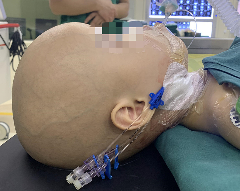 Head of the child after anesthesia.