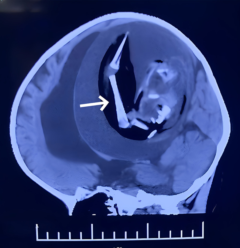 Preoperative computed tomography (CT) image of the head. CT reconstruction in the sagittal position showed a large mass in the cerebral hemisphere with a maximum diameter of 13 cm, clear and smooth boundary, and internal bone structure. Fetal shape was observed in multi slice, with obvious compression near the cerebral parenchyma, and hydrosis of both ventricles and the third ventricle. The arrow points to the long bone.