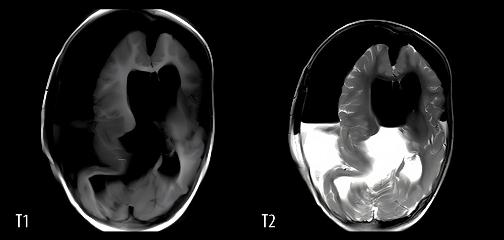 Following brain tumor surgery, the intracranial and lateral ventricles in axial T1 and T2 images displayed flattened air and liquid, increased ventricle size, reduced brain parenchyma volume, and absence of brain tumors.