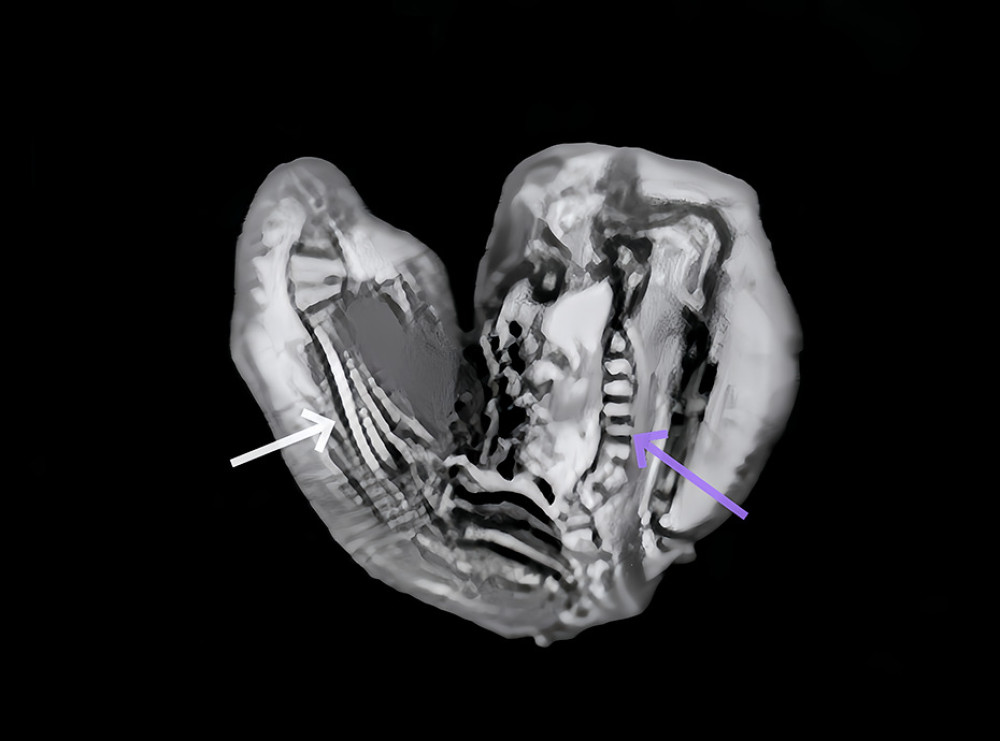 The spinal column (purple arrow) and long bone (white arrow) morphology were shown on magnetic resonance imaging of the fetus in fetu.