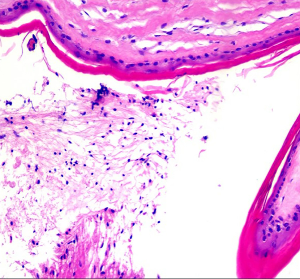 Squamous epithelium with hyperkeratosis.