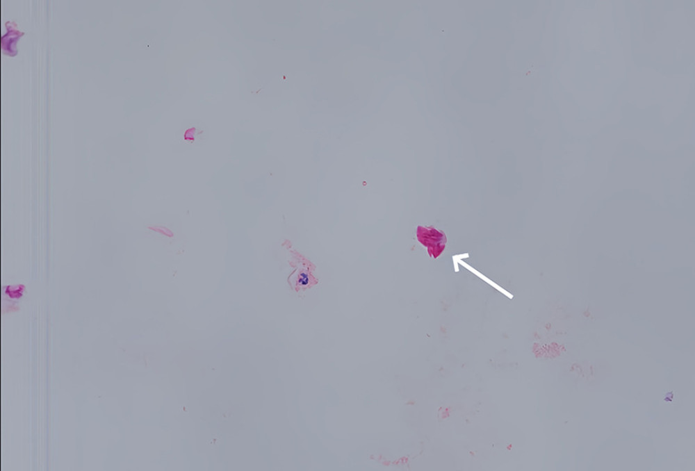 Brown capsule fluid containing amniotic fluid. The white arrow shows amniotic epithelial cells.