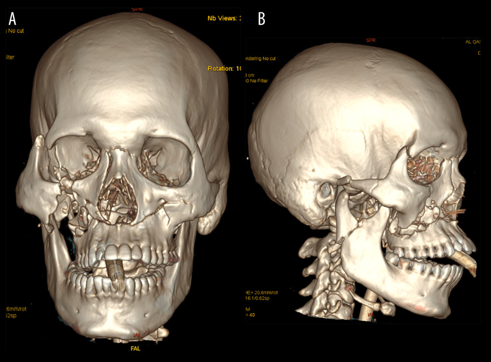 (A, B) CT Head showing Le Forte I fracture.