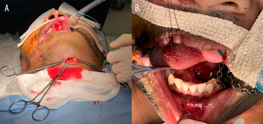 (A, B) Oral endotracheal tube in place with the submental incision exposed.