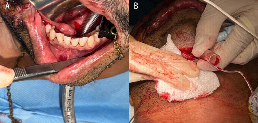 (A, B) Reinforced endotracheal tube passing through the submental incision.