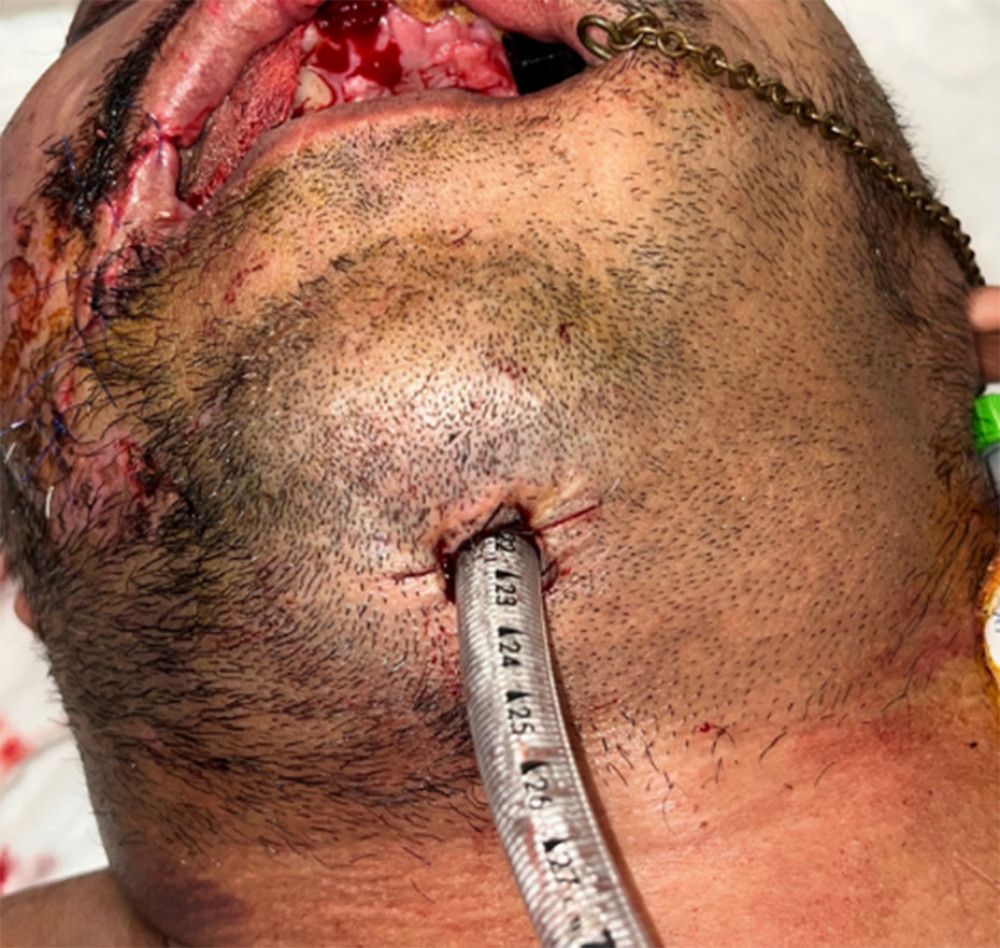 Reinforced endotracheal tube fixed with silk sutures.