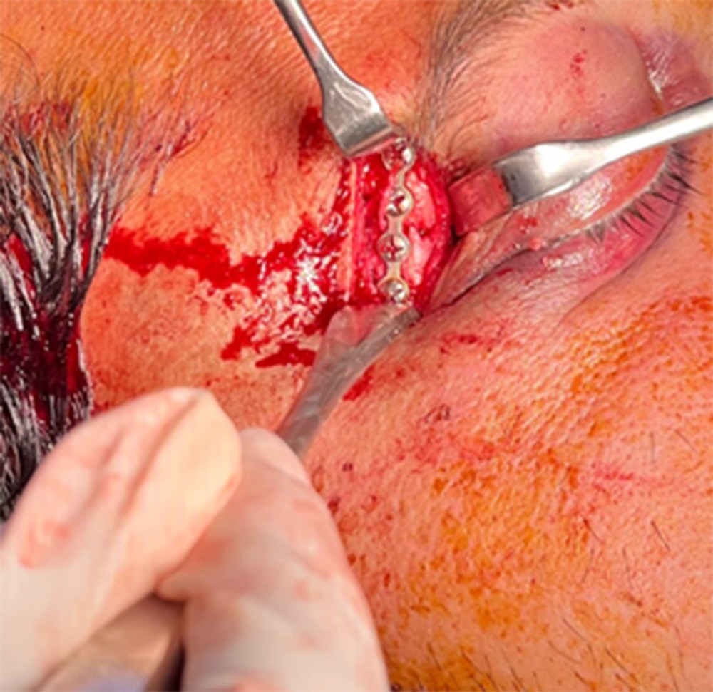 Fracture at the F-Z suture identified, reduced, and fixed with titanium plate.