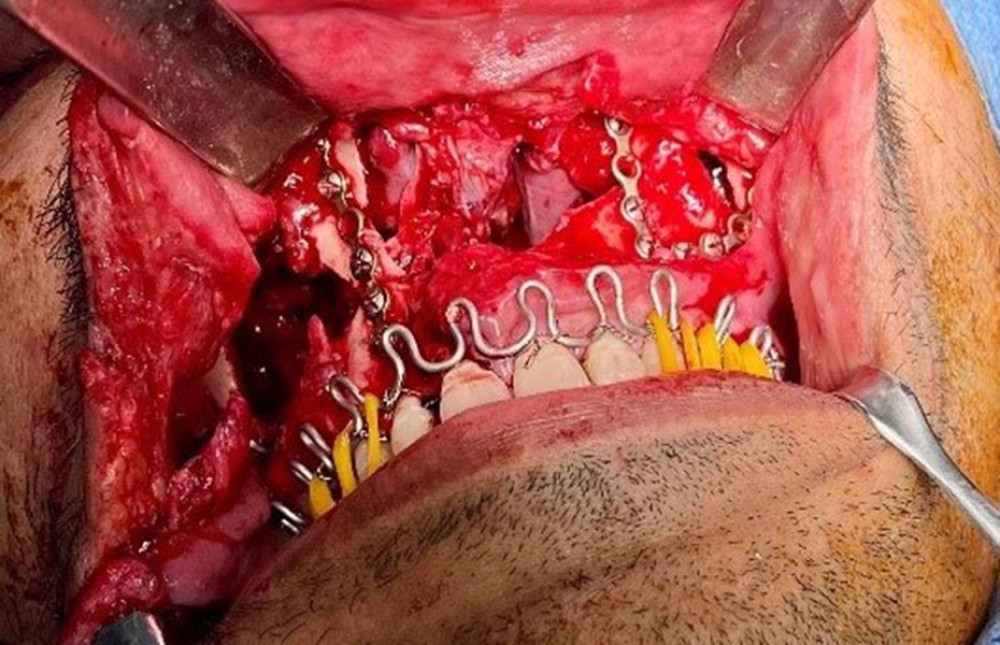 Reduction of the fracture and plates fixation.