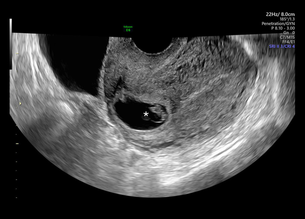 Transvaginal ultrasound diagnosing cesarean scar ectopic pregnancy (asterisk marks the fetal pole within the gestational sac of the cesarean scar ectopic pregnancy).