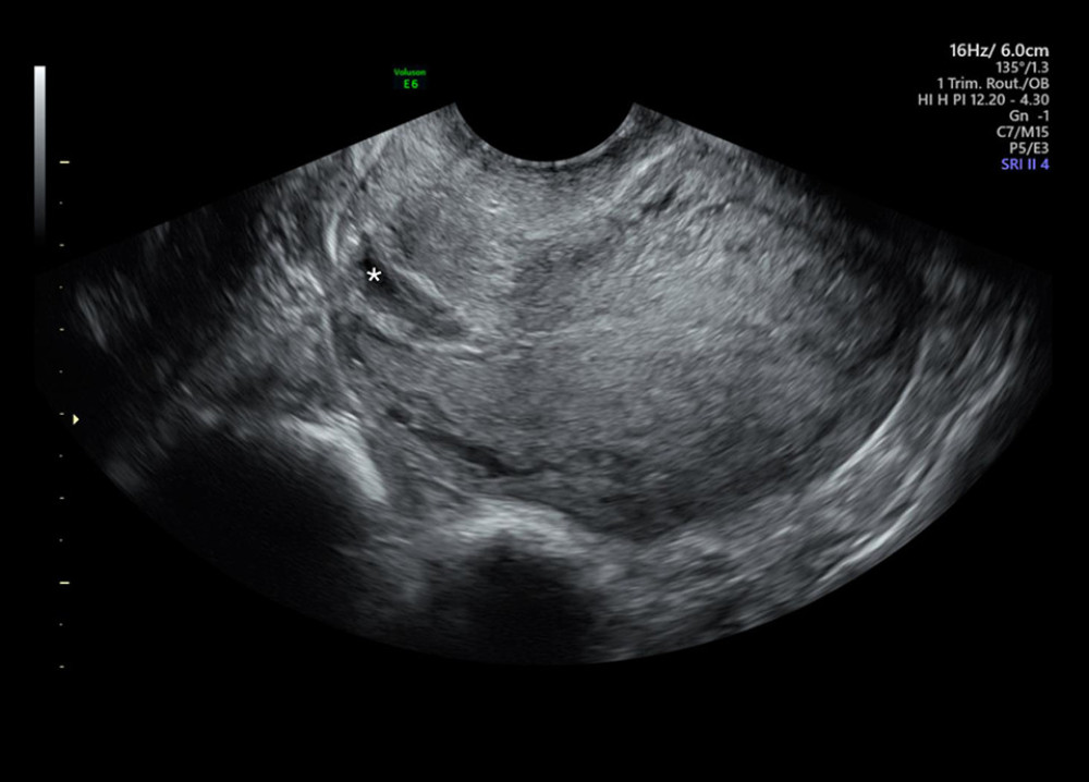 Transvaginal ultrasound after treatment, prior to hysteroscopy procedure. Pregnancy tissue has disintegrated, with minimal amorphous tissue mass seen (asterisk indicates disintegrated tissue).