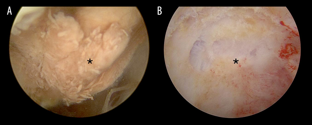 (A) Hysteroscopic visualization of retained gestational mass that appears necrotic (asterisk indicates retained gestational mass). (B) Intra-uterine cavity after hysteroscopic resection of retained gestational mass (asterisk indicates the resected area).