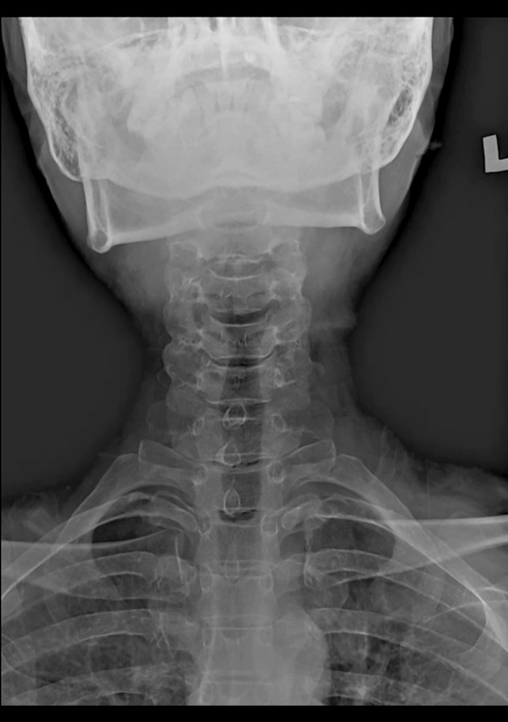 The anteroposterior view of the cervical radiograph revealed no significant abnormality.
