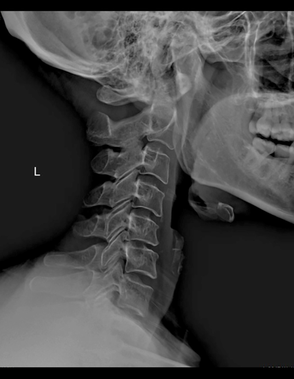 The lateral view of the cervical radiograph did not provide clear visualization of the elongated styloid process due to the overlapping of multiple bone structures, distortion, and magnification caused by various angles.