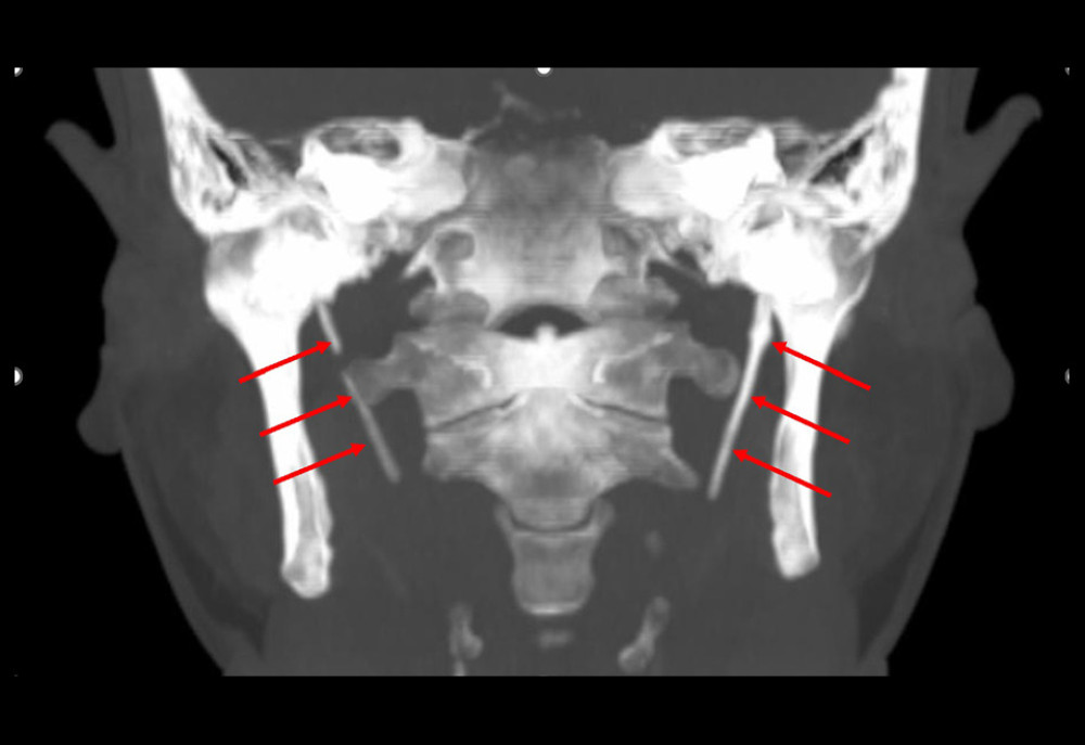 This is a non-contrasted CT of the neck, which demonstrated bilateral styloid process elongation (red arrows). It is the coronal maximum intensity projection image of the CT scan on bone setting showing bilateral styloid process elongation.