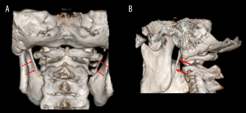 (A, B) This is a representative image from the Volume Rendering Technique reconstruction of the CT scan in bone setting, showing bilateral styloid process elongation of 3.6 cm on the right side and 3.7 cm on the left side (red arrows). The normal length of the styloid process in an adult is approximately 2.5 cm, and a styloid process measuring more than 3.0 cm is considered elongated.