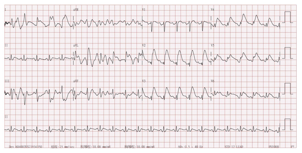 A 12-lead electrocardiogram obtained after the return of spontaneous circulation revealing ventricular tachycardia with hyperacute T-wave and ST elevation are observed in V2 to V6.