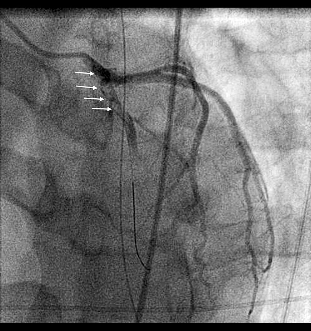 Coronary angiography (left anterior oblique view) showing multiple radiolucent lumens from the ostial to the proximal portion of the left anterior descending artery with near-total occlusion (white arrows).