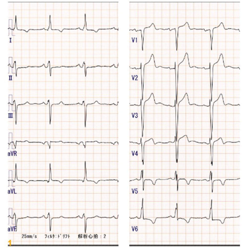 An electrocardiogram showed negative T waves in the I, aVL V5, and V6 leads.