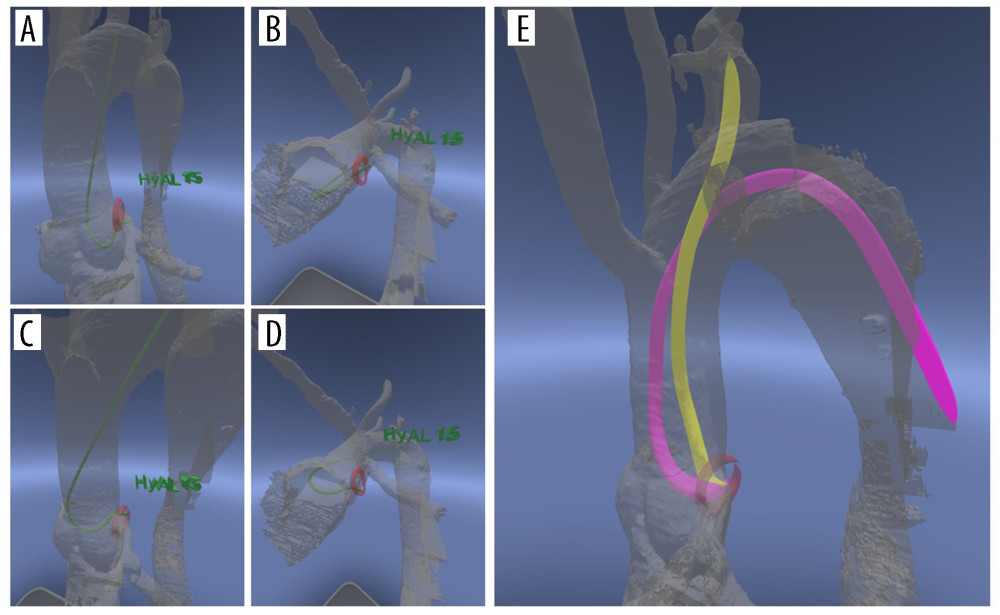 (A, B) Guide catheter, Hyperion Amplatz Left 1.5 engagement simulation from the right upper limb by virtual reality (A: right anterior oblique view, B: left anterior oblique caudal view). Left main trunk ostium (red circle). (C, D) Guide catheter, Hyperion Amplatz Left 1.5 engagement simulation from the lower limb by virtual reality (C: right anterior oblique view, D: left anterior oblique caudal view). (E) Guide catheter passage line from right upper limb (yellow line) or lower limb (pink line).