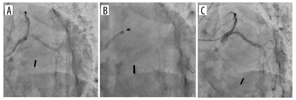 (A) Guide catheter engagement (Hyperion Amplatz Left 1.5, 7-French). (B) Percutaneous coronary intervention with Rota bar 2.0 mm. (C) Final angiography.