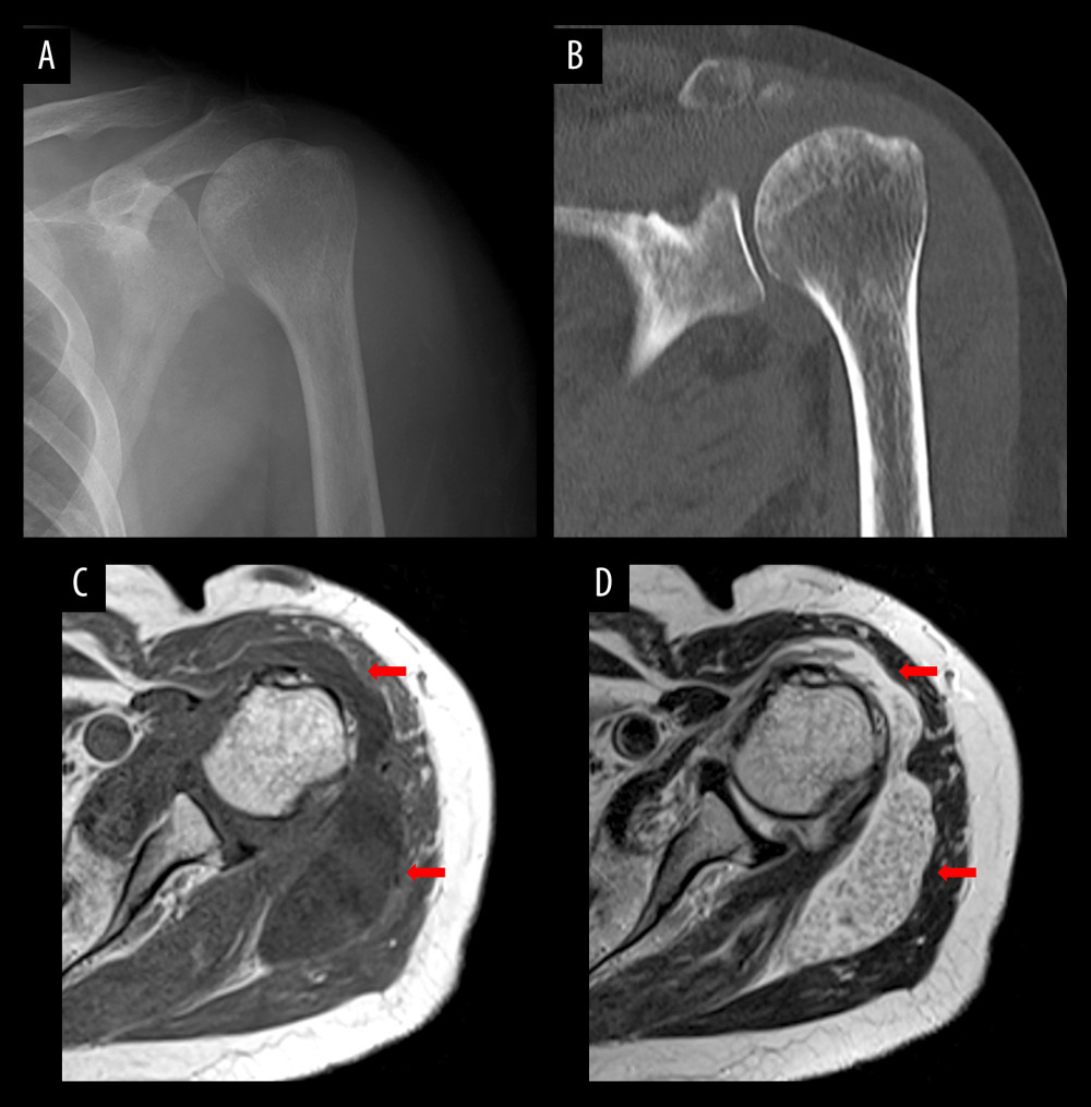 Preoperative images. (A) Plain radiograph. (B) Plain computed tomography (CT). No clear signs of bone destruction. (C) Plain magnetic resonance imaging (MRI) T1. (D) Plain MRI T2. C and D showed an area of low- and high-intensity on T1 and T2, respectively, and fluid accumulation in the area from the anterior to the posterior of the left shoulder joint and extra-articular area. Arrows indicate abscesses.
