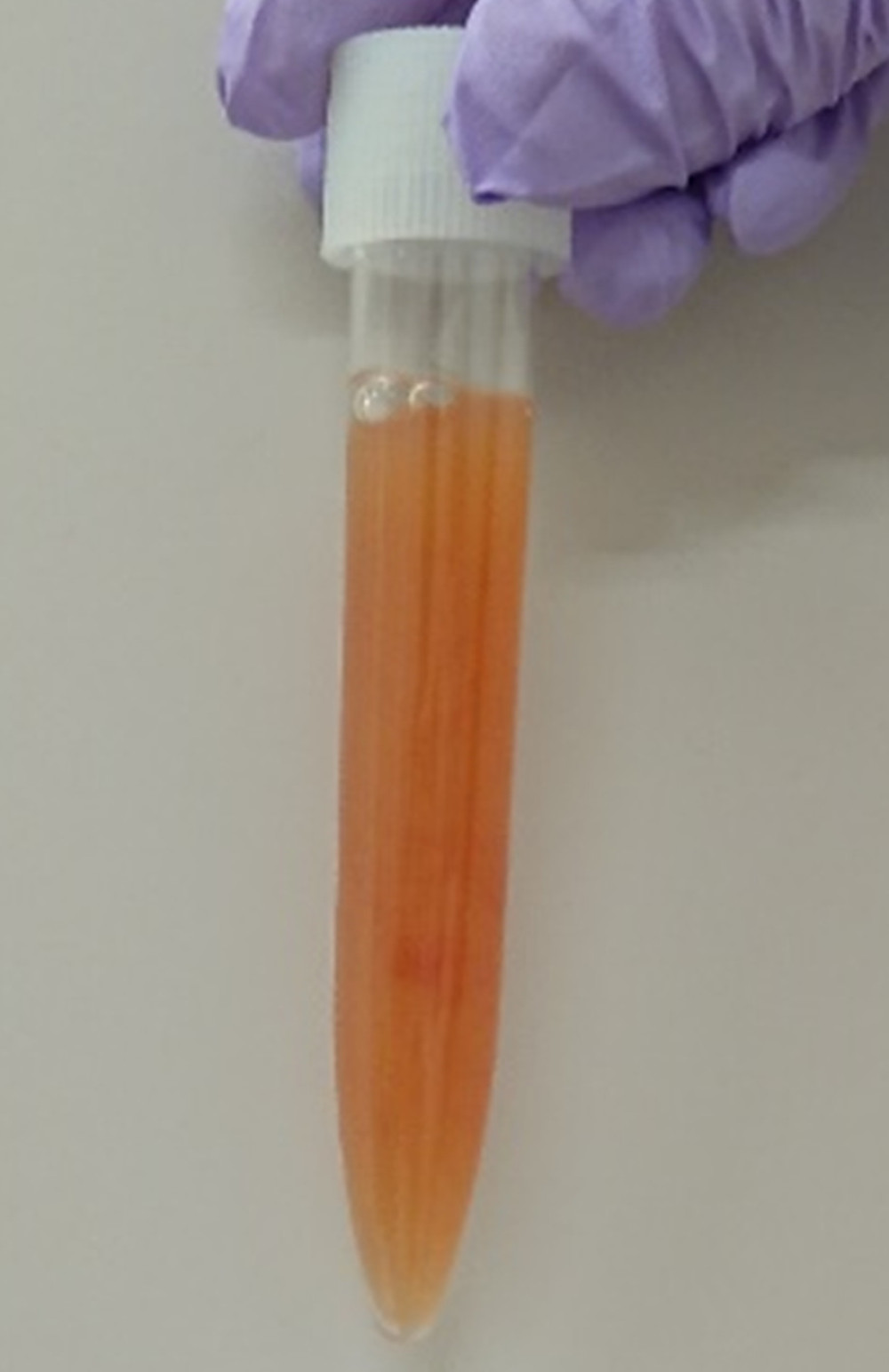 Puncture fluid. Slightly cloudy joint fluid mixed with blood was noted.