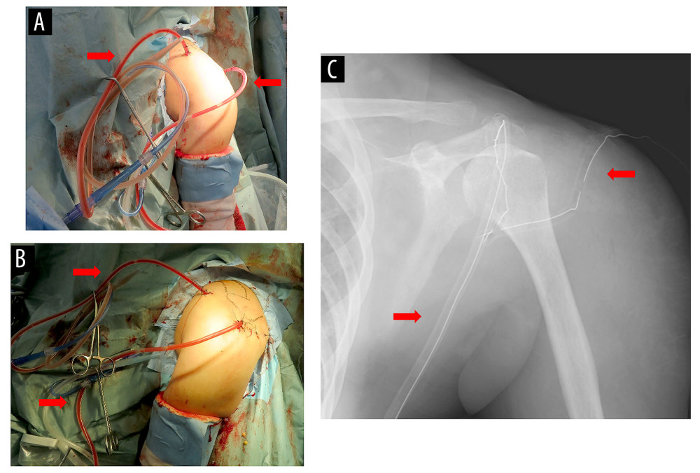 Immediate postoperative images. (A, B) Clinical photography. (C) Plain X-ray image. A drain tube was inserted into the joint from the anterior portal made with skin incision for arthroscopic surgery. After the lateral deltoid muscle was split, the other drain tube was placed at the posterior of the humerus. Arrows indicate the drain tube of the continuous local antibiotic perfusion (CLAP).