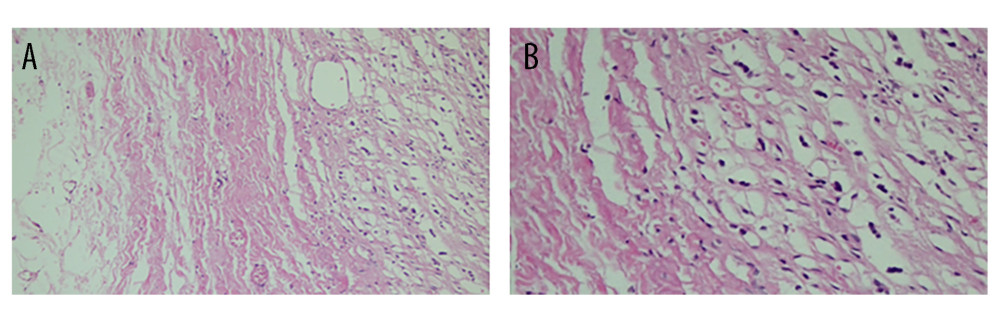 Photomicrographs of the histopathology of the adrenal biopsy showing the cells are arranged loosely, with significant gaps between some of them. Additionally, there are many vacuole-like structures in the cytoplasm, all of which support the diagnosis of cyst.