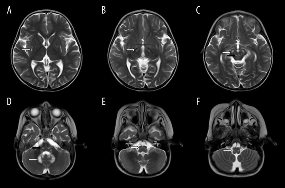 Axial T2W images of brain in a 2-year-old boy with Leigh disease and SURF1 mutation demonstrating hyperintense signals in A) posterior lentiform nucleus(white arrow), B) subthalamic nucleus(white arrow), C) substantia nigra(white arrow) and red nucleus (black arrow), D) dentate nucleus(white arrow) and lemniscus(black arrow), E) olivary nuclei(white arrow), and F) medial lemnisci.