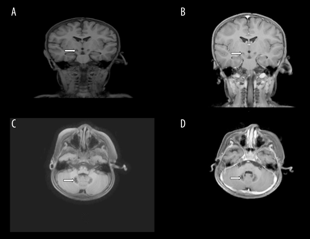 Pre- and post-contrast coronal (A, B) and axial (C, D) T1W images of brain in a 2-year-old boy with Leigh disease and SURF1 mutation demonstrating non-enhancing hypointense lesions in bilateral subthalamic nuclei (white arrow) and bilateral dentate nuclei (black arrow) of the brain.