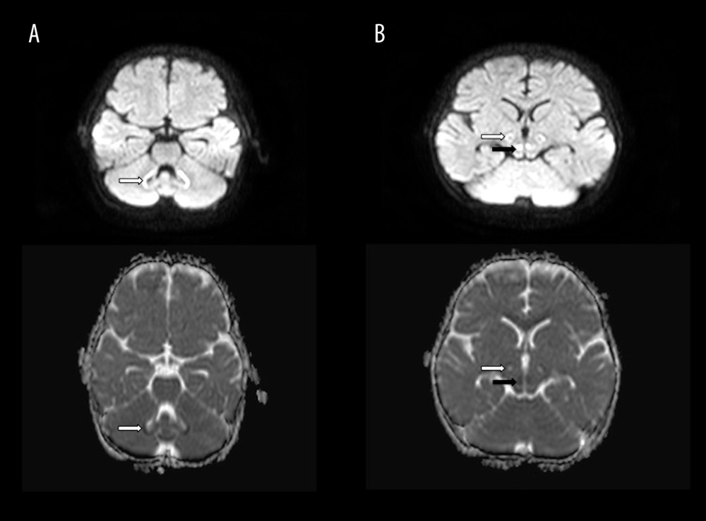 Axial diffusion MRI and corresponding ADC image of brain in a 2-year-old boy with Leigh disease an SURF1 mutation demonstrating diffusion restriction with corresponding reduced ADC in A) bilateral dentate nuclei (white arrow) and B) substantia nigra (white arrow) and red nuclei (black arrow).