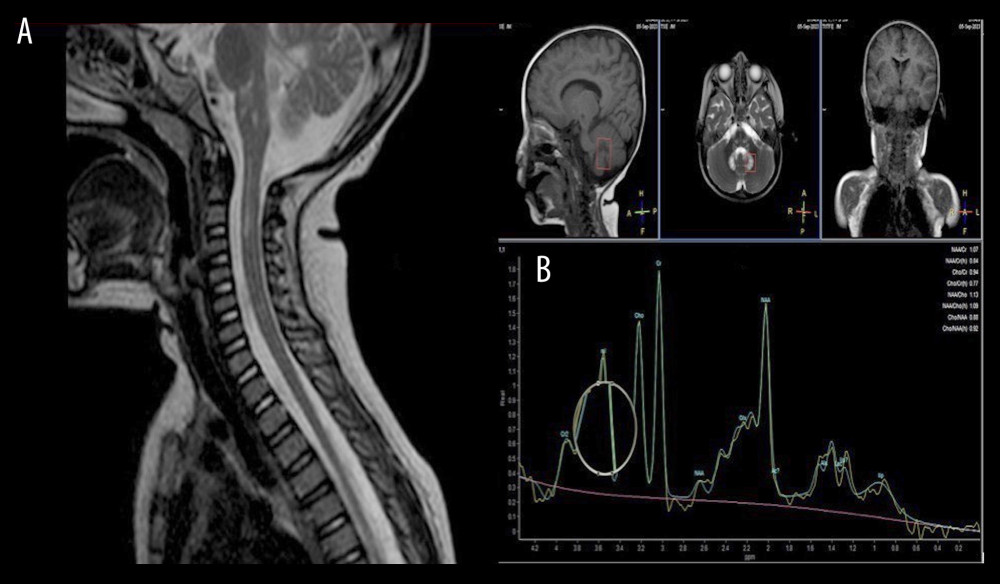 Sagittal T2W magnetic resonance imaging of cervical spinal cord demonstrating: A) hyperintense signal changes in medulla oblongata and extending into cervical spinal cord, and B) magnetic resonance spectroscopy of the lesion in dentate nucleus demonstrating mild reduction in N-acetyl aspartate peak with elevated choline peak and prominent lactate peak.