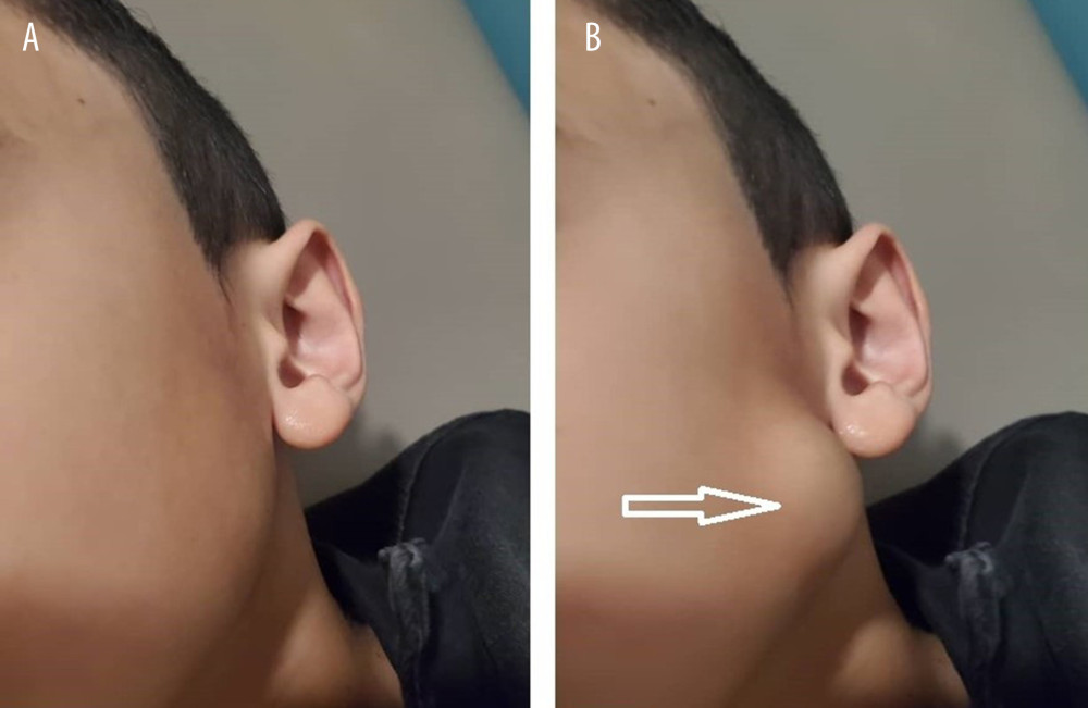 Patient image A) during open mouth, and B) with clenched teeth, demonstrates focal left cheek swelling increased by clenching of teeth (arrow).