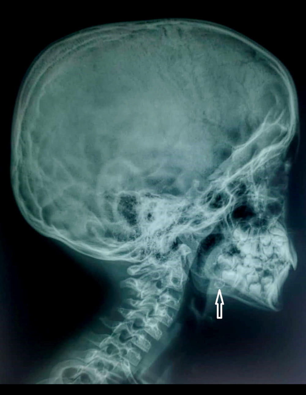 Lateral X-ray image revealed rounded calcification over the left mandibular region (arrow).