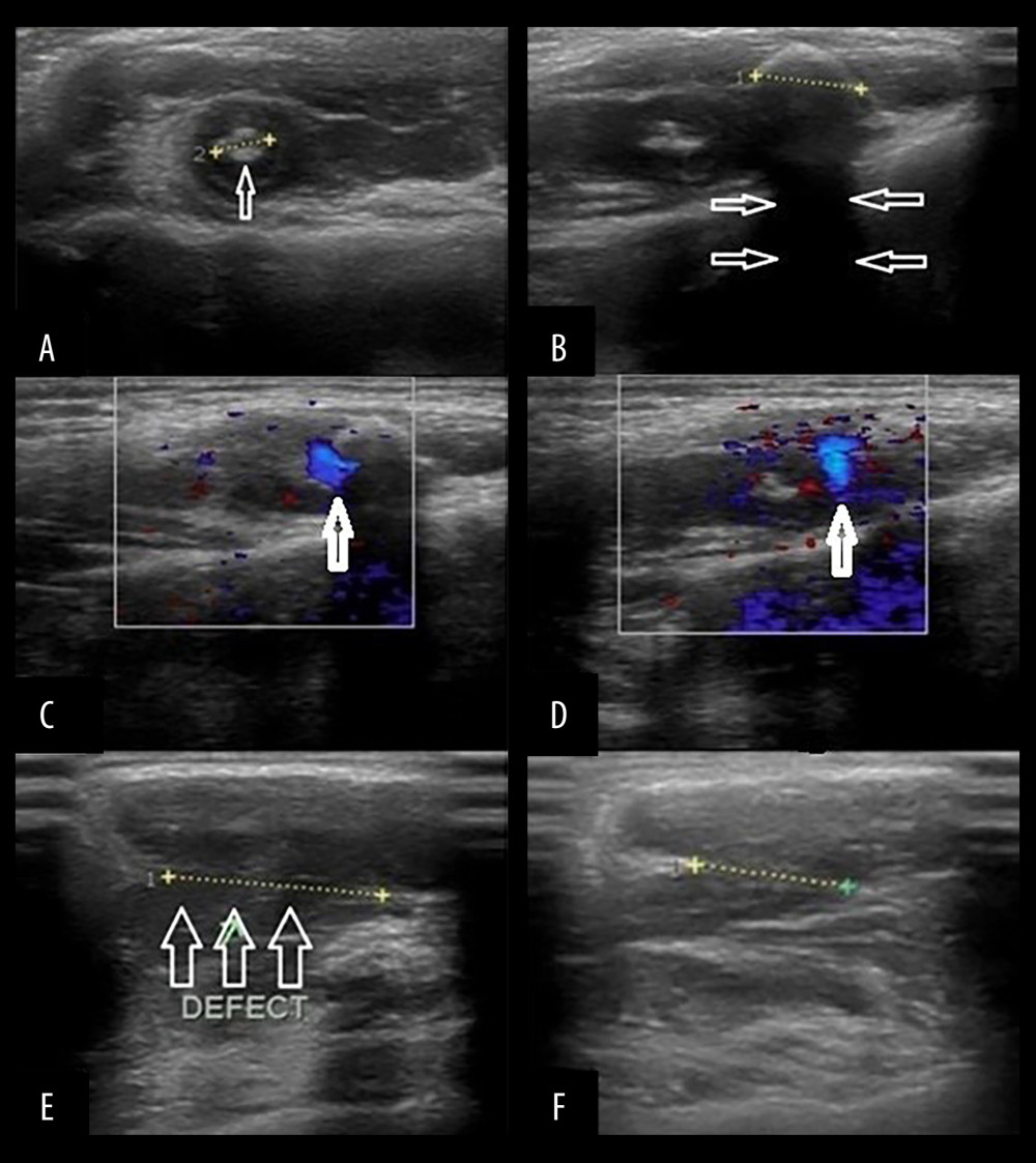 Ultrasonography images revealed bulky left masseter muscle, with mild heterogeneous structure, and evidence of 2 rounded calcified foci (A, arrow), with calcification-related distal acoustic shadowing (B, arrows). Venous flow is detected on color Doppler images (C, D). No arterial waveform noted on spectral flow analysis; images not shown. Ultrasonography images with clenching of teeth revealed superficial facial hernia defect overlying left masseter muscle with focal muscular herniation through it (C, arrows), which is improved by stopping clenching of teeth (D).