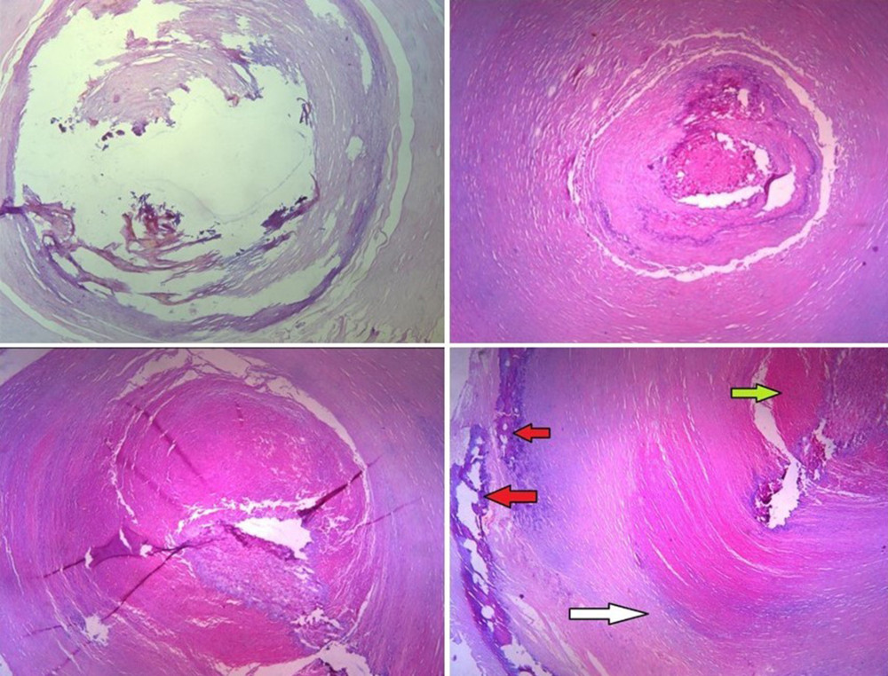 Histopathological microscopic images of hematoxylin and eosin stain (H&E stain ×5) showing dilated blood vessels obliterated lumen by fibrin thrombi (green arrow), with hyaline fibrosis (white arrow) and focal calcification (red arrows) consistent with radiological suggestion of venous malformation.