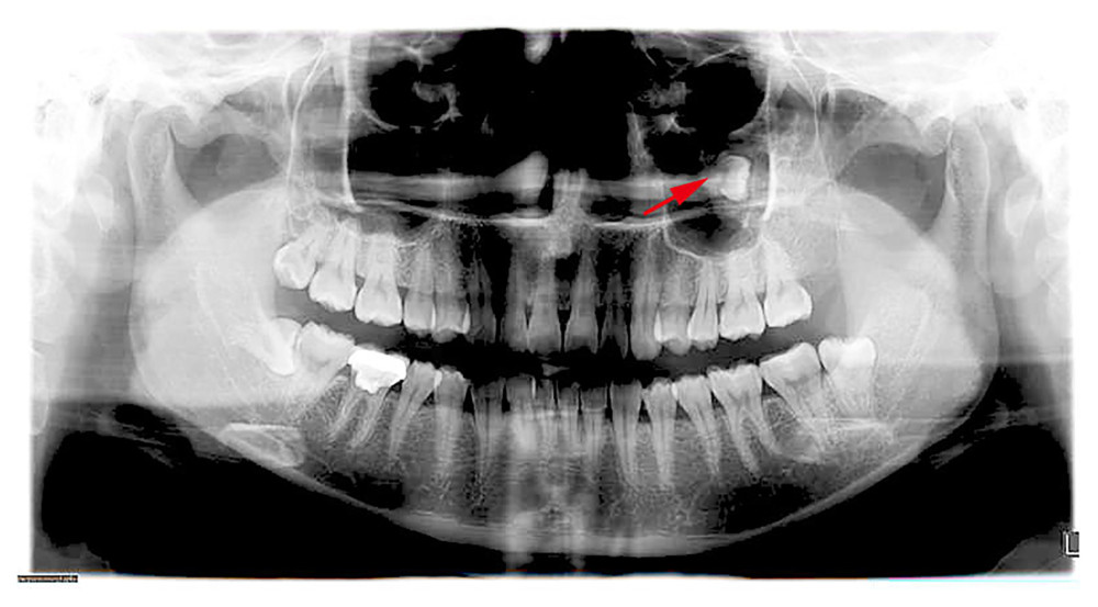 The panoramic radiography revealed the absence of the third molar on the distal side of the second molar, with a high-density image within the left maxillary sinus, resembling a tooth, and surrounded by a soft-tissue shadow.