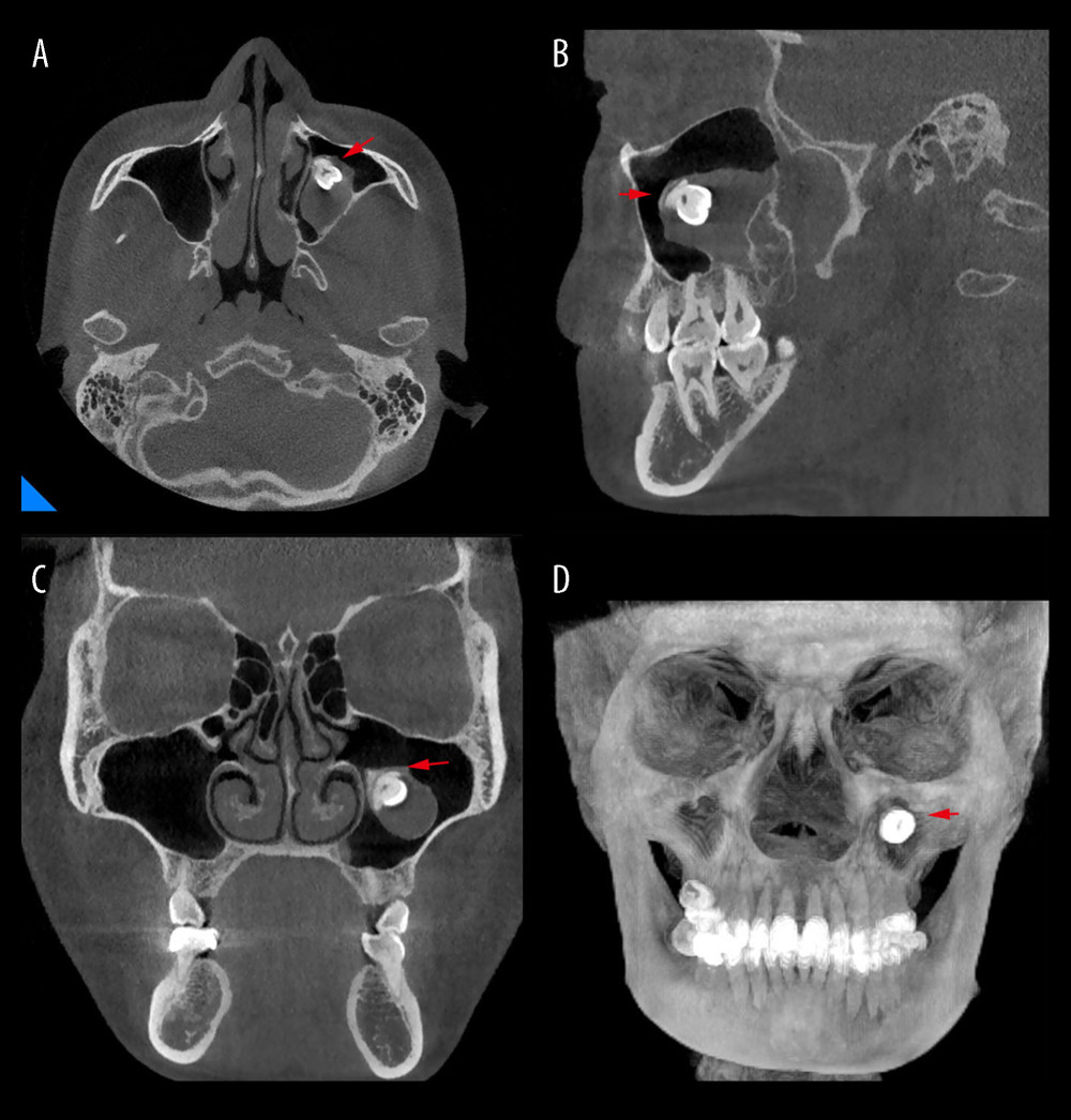 CBCT imaging findings of odontogenic keratocyst in maxillary sinus with ectopic third molar. (A) Cross-section; (B) Sagittal plane; (C) Coronal plane; (D) Three-dimensional reconstruction.