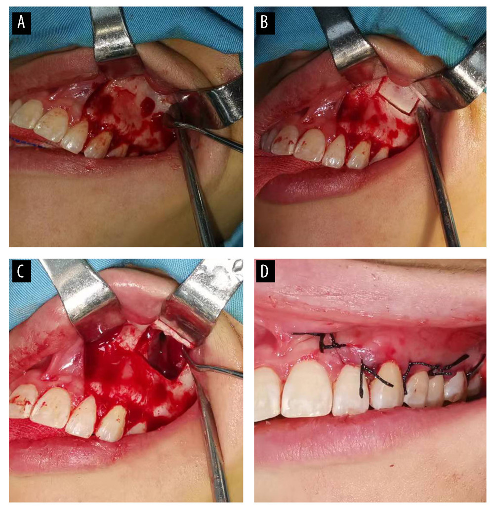 The cyst was scraped and the tooth was removed under general anesthesia via the Caldwell-Luc approach. (A) A cut was made from the front of tooth 22 to the back of tooth 26 using a 15-gauge lancet, and the mucoperiosteal flap was turned up. (B) The anterior lateral wall of maxillary sinus was cut with ultrasonic bone scalpel (Misonix Inc., Farmingdale, New York, USA; 300 mW). (C) The keratocyst was exposed and scraped. (D) The incision was sutured (4-0 silk suture).