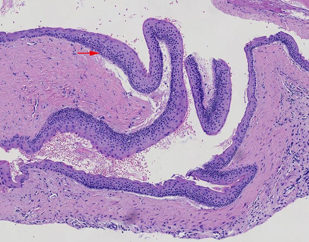 The postoperative pathological examination indicated the presence of incomplete keratosis on the surface of the capsule wall and a palisade arrangement of basal cells, findings that were in accordance with a diagnosis of odontogenic keratosis.