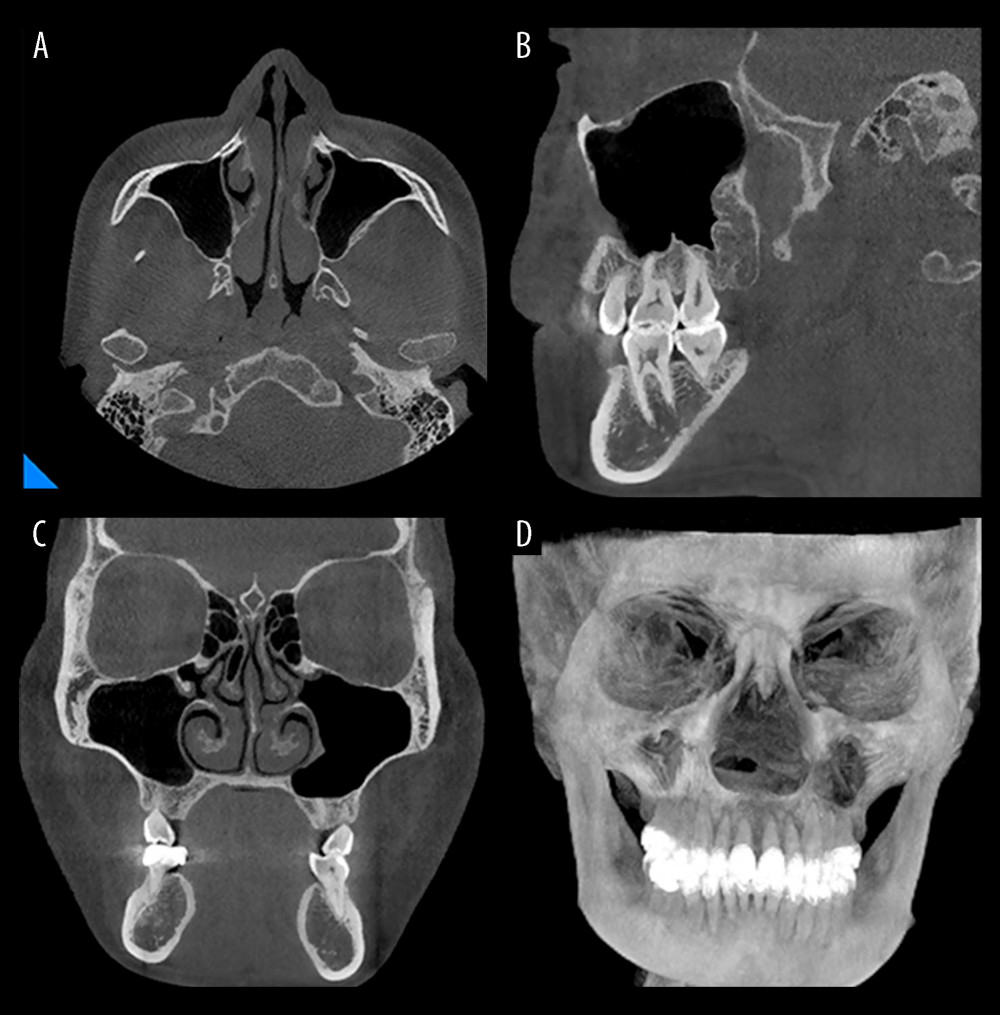 CBCT images taken at 6-month follow-up revealed no noteworthy signs of recurrence. (A) Cross-section. (B) Sagittal plane. (C) Coronal plane. (D) Three-dimensional reconstruction.
