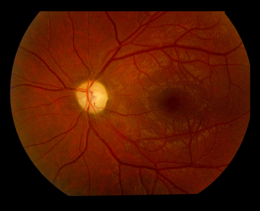Left optic disc pallor.