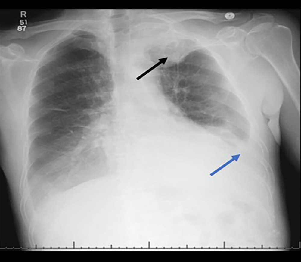 Initial chest X-ray on presentation. Radiographic chest X-ray that was obtained on presentation to our institution. Black arrow illustrates the left apical mass that was identified. Blue arrow identifies the moderate left-sided pleural effusion that was also noted.
